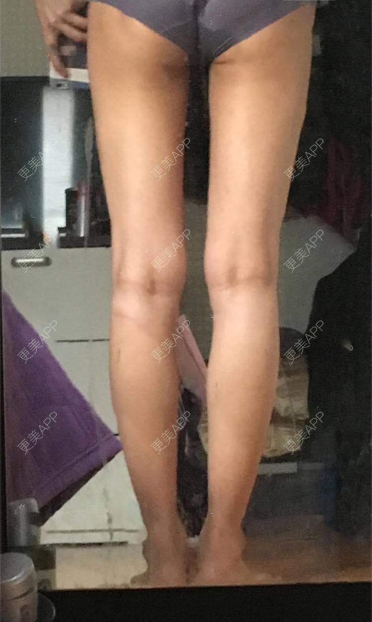 更美 - 蔡东亮 医生的吸脂瘦大腿经验 | 吸脂瘦大腿