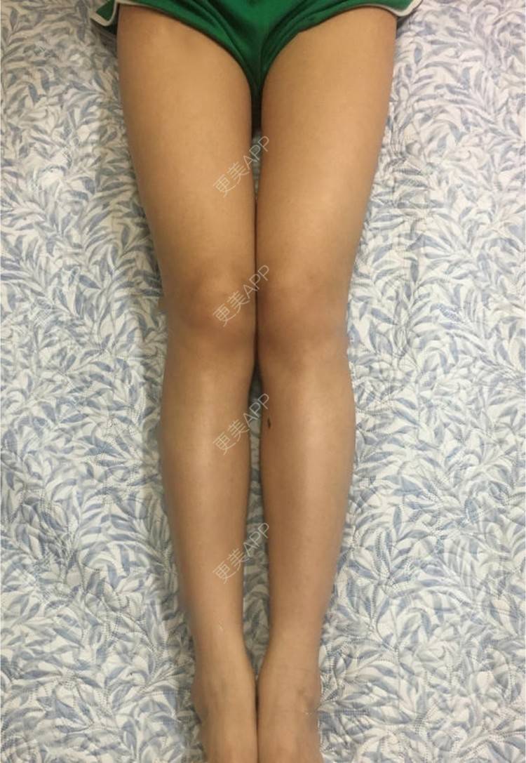 更美 - 蔡东亮 医生的吸脂瘦大腿经验 | 吸脂瘦大腿