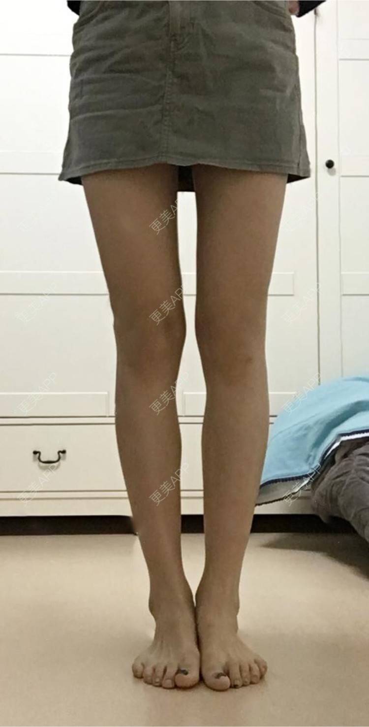 更美 - 蔡东亮 医生的吸脂瘦大腿经验 | 吸脂瘦大腿