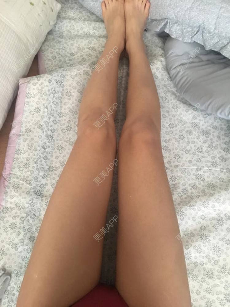 更美 - 蔡东亮 医生的吸脂瘦大腿经验 | 吸脂瘦大腿