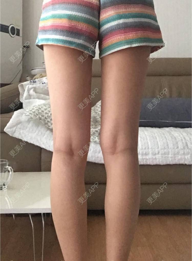 更美 - 蔡东亮 医生的吸脂瘦大腿经验 | 吸脂瘦大腿