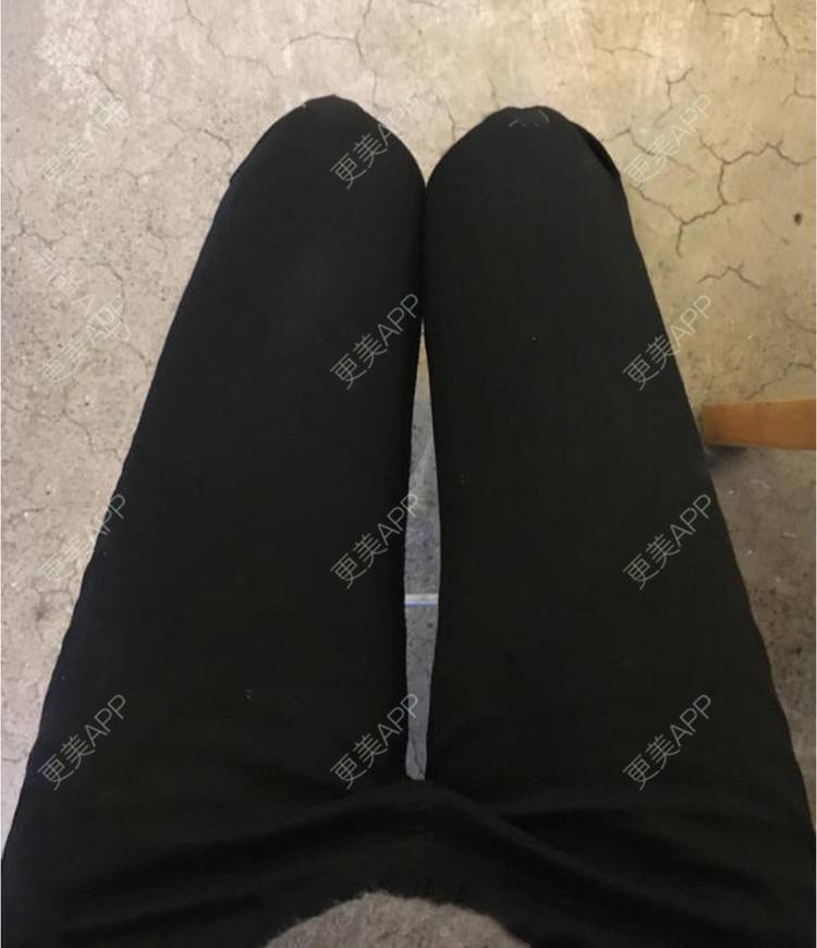 更美 - 蔡东亮 医生的吸脂瘦大腿经验 | 吸脂瘦大腿