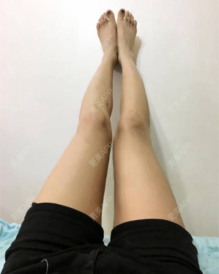 更美 - 蔡东亮 医生的吸脂瘦大腿经验 | 吸脂瘦大腿
