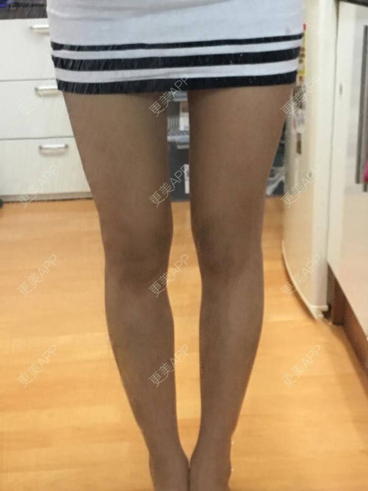 更美 - 蔡东亮 医生的吸脂瘦大腿经验 | 吸脂瘦大腿