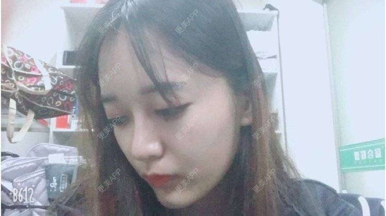 更美 - 匆匆1108的全脸整形套餐经验 | 全脸整形套餐 | 鼻部整形 | 武汉 | 隆鼻