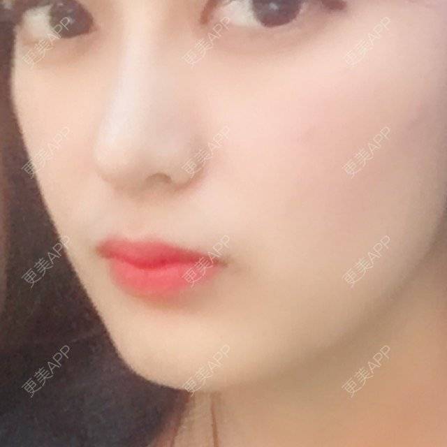 更美 - 匆匆1108的全脸整形套餐经验 | 全脸整形套餐 | 鼻部整形 | 武汉 | 隆鼻