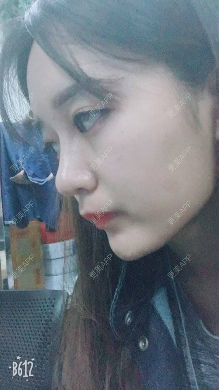 更美 - 匆匆1108的全脸整形套餐经验 | 全脸整形套餐 | 鼻部整形 | 武汉 | 隆鼻