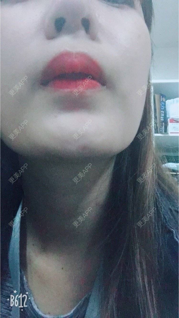 更美 - 匆匆1108的全脸整形套餐经验 | 全脸整形套餐 | 鼻部整形 | 武汉 | 隆鼻