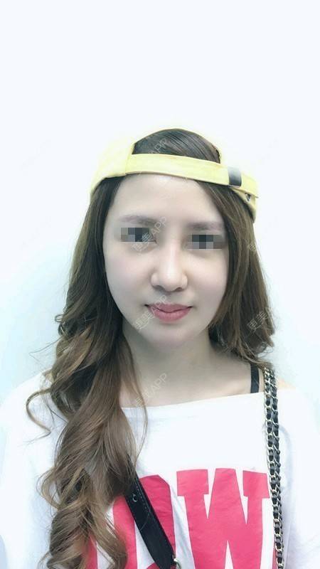 更美 - 孤身战群魔的鼻部膨体假体取出经验 | 北京 | 鼻部膨体假体取出
