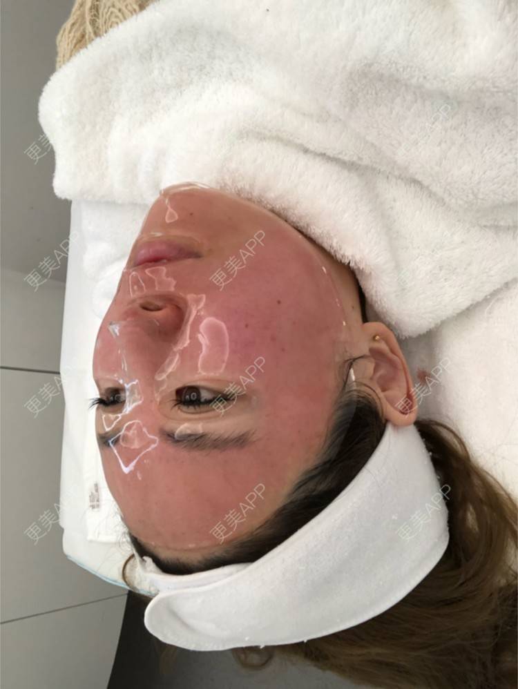 更美 - STELLASS的水光项目经验 | 鼻部修复 | 长沙 | V脸套餐 | 武汉 | 北京 | 水光项目 | 昆明 | 双眼皮 | 上海 | 祛眼袋 | 假体隆胸 | 隆鼻 | 鼻部多项 | 南昌 | 沈阳 | 深圳 | 吸脂 | 南京 | 南宁 | 自体脂肪全面部填充 | 祛斑祛色素 | 面部脱毛 | 重庆 | 郑州 | 杭州 | 美白嫩肤 | 厚唇改薄 | 颈部