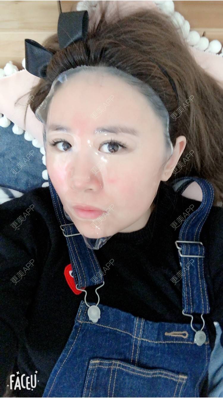 更美 - STELLASS的水光项目经验 | 鼻部修复 | 长沙 | V脸套餐 | 武汉 | 北京 | 水光项目 | 昆明 | 双眼皮 | 上海 | 祛眼袋 | 假体隆胸 | 隆鼻 | 鼻部多项 | 南昌 | 沈阳 | 深圳 | 吸脂 | 南京 | 南宁 | 自体脂肪全面部填充 | 祛斑祛色素 | 面部脱毛 | 重庆 | 郑州 | 杭州 | 美白嫩肤 | 厚唇改薄 | 颈部