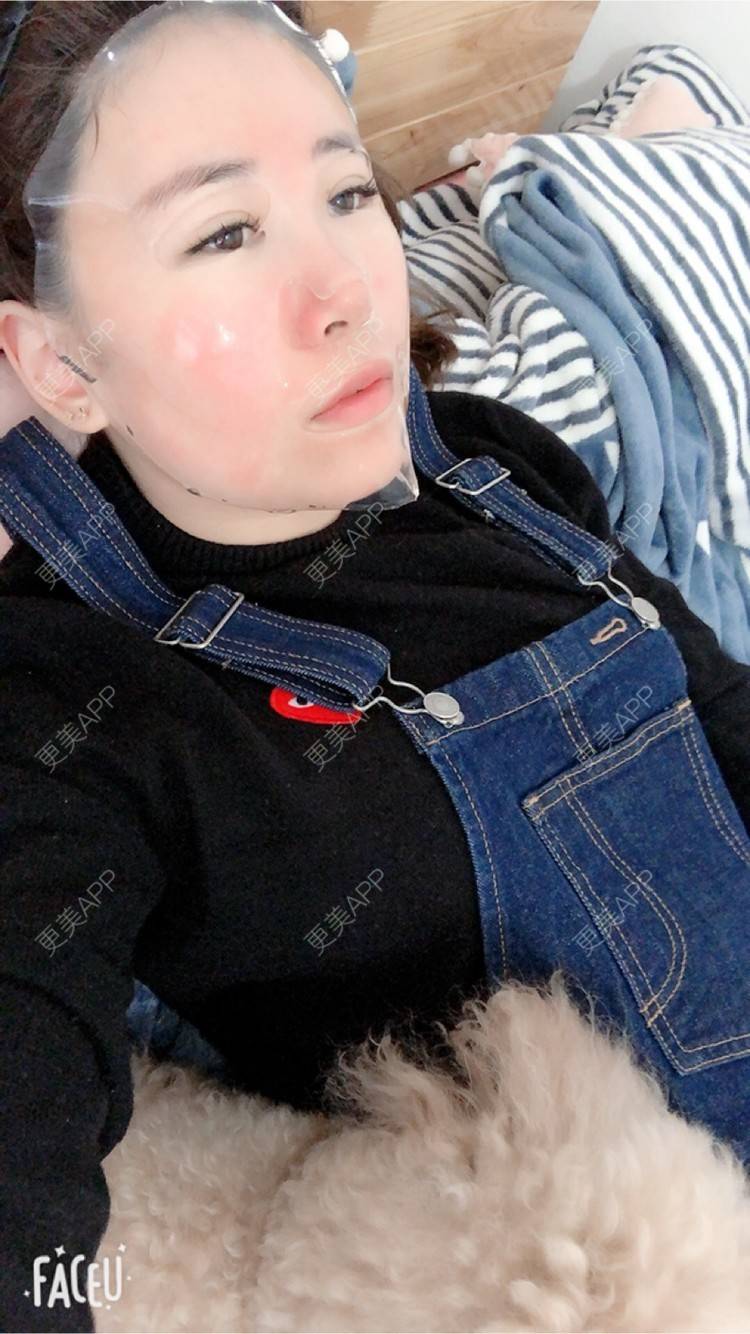 更美 - STELLASS的水光项目经验 | 鼻部修复 | 长沙 | V脸套餐 | 武汉 | 北京 | 水光项目 | 昆明 | 双眼皮 | 上海 | 祛眼袋 | 假体隆胸 | 隆鼻 | 鼻部多项 | 南昌 | 沈阳 | 深圳 | 吸脂 | 南京 | 南宁 | 自体脂肪全面部填充 | 祛斑祛色素 | 面部脱毛 | 重庆 | 郑州 | 杭州 | 美白嫩肤 | 厚唇改薄 | 颈部