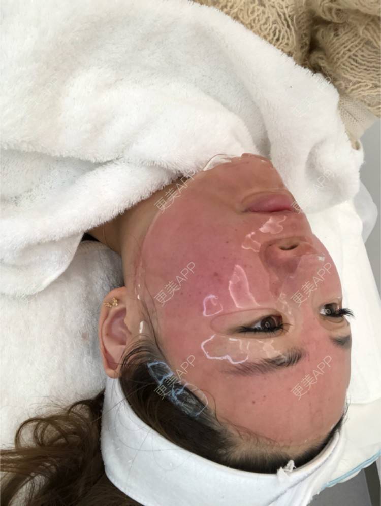 更美 - STELLASS的水光项目经验 | 鼻部修复 | 长沙 | V脸套餐 | 武汉 | 北京 | 水光项目 | 昆明 | 双眼皮 | 上海 | 祛眼袋 | 假体隆胸 | 隆鼻 | 鼻部多项 | 南昌 | 沈阳 | 深圳 | 吸脂 | 南京 | 南宁 | 自体脂肪全面部填充 | 祛斑祛色素 | 面部脱毛 | 重庆 | 郑州 | 杭州 | 美白嫩肤 | 厚唇改薄 | 颈部