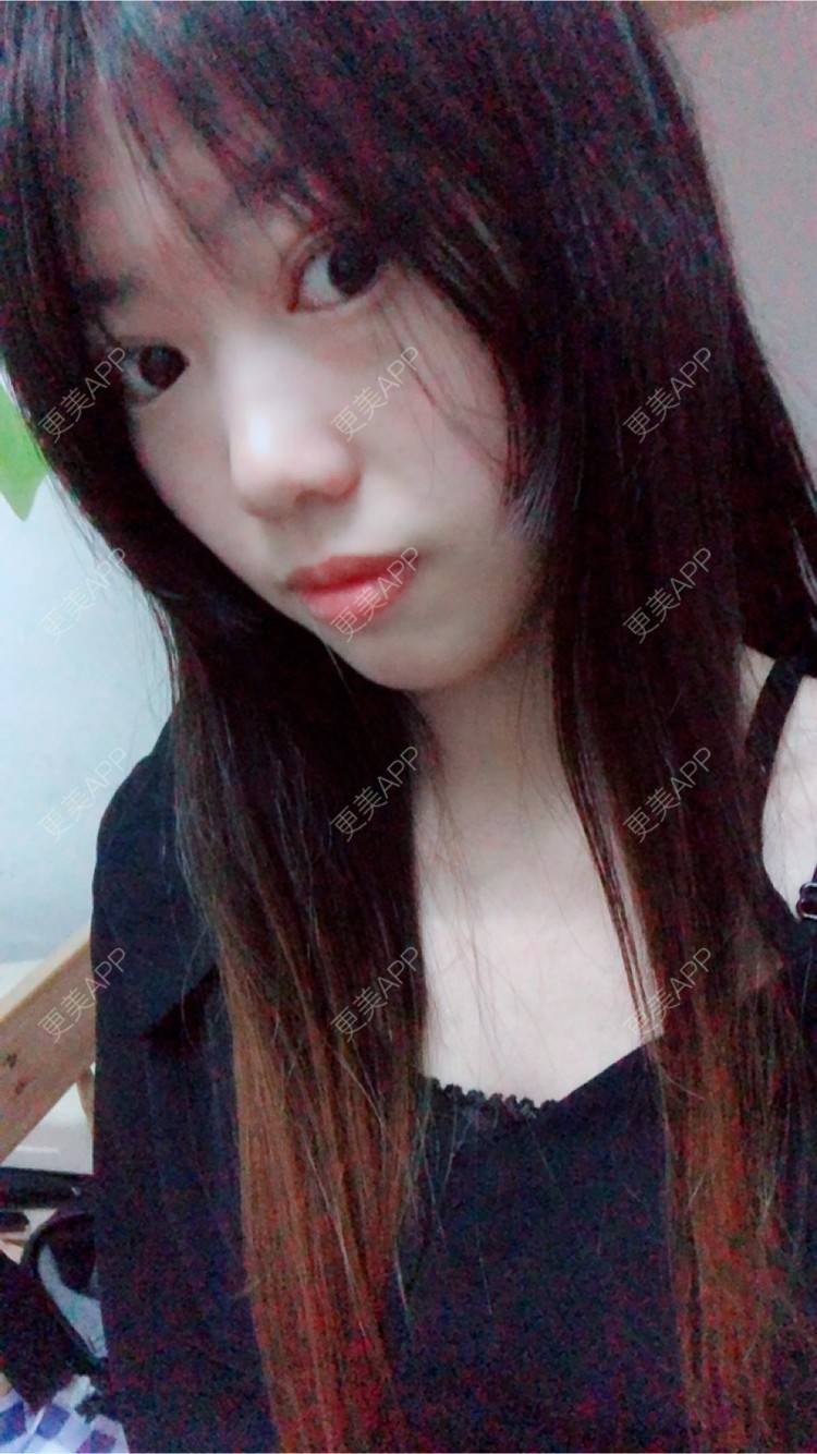 更美 - 更美用户oj4IIT2zhJ的定点双眼皮经验 | 厦门 | 定点双眼皮