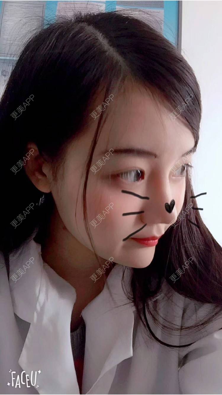 更美 - 小郭子1996的祛眼袋经验 | 北京 | 不开刀去眼袋 | 祛眼袋 | 激光去眼袋