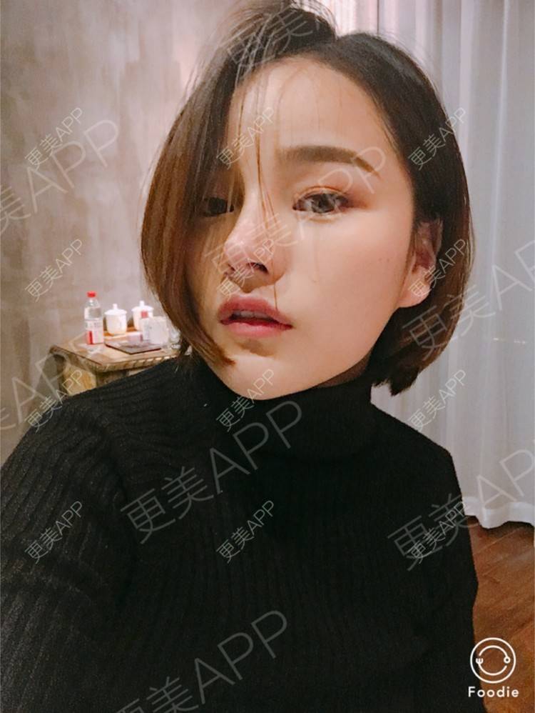 更美 - 更美用户7JqOSIso4n的鼻部多项经验 | 假体取出 | 肋软骨垫鼻尖 | 鼻部多项 | 杭州