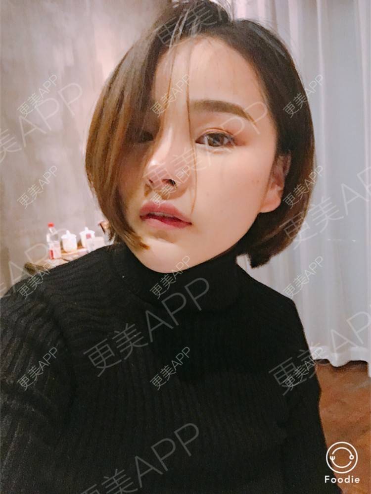 更美 - 更美用户7JqOSIso4n的鼻部多项经验 | 假体取出 | 肋软骨垫鼻尖 | 鼻部多项 | 杭州