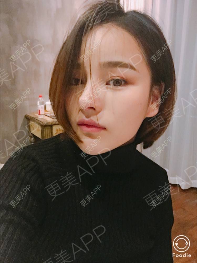 更美 - 更美用户7JqOSIso4n的鼻部多项经验 | 假体取出 | 肋软骨垫鼻尖 | 鼻部多项 | 杭州