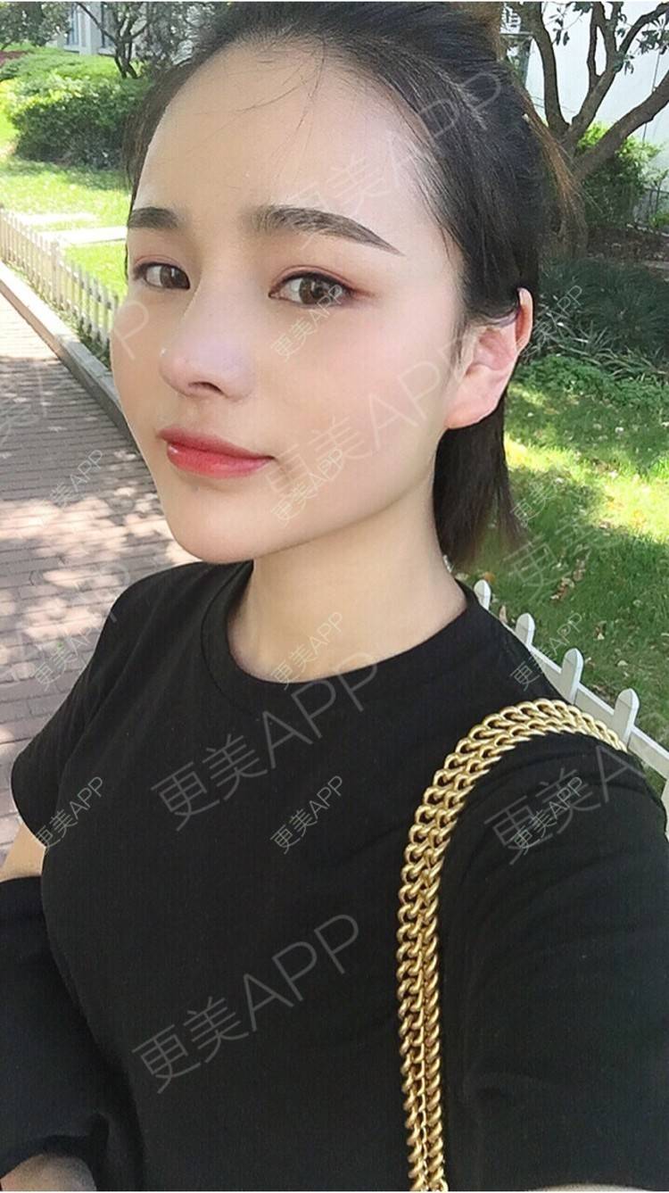 更美 - 更美用户7JqOSIso4n的鼻部多项经验 | 假体取出 | 肋软骨垫鼻尖 | 鼻部多项 | 杭州