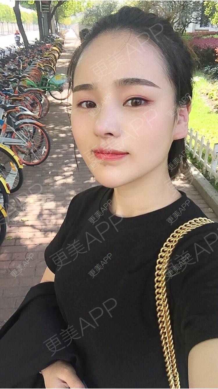 更美 - 更美用户7JqOSIso4n的鼻部多项经验 | 假体取出 | 肋软骨垫鼻尖 | 鼻部多项 | 杭州