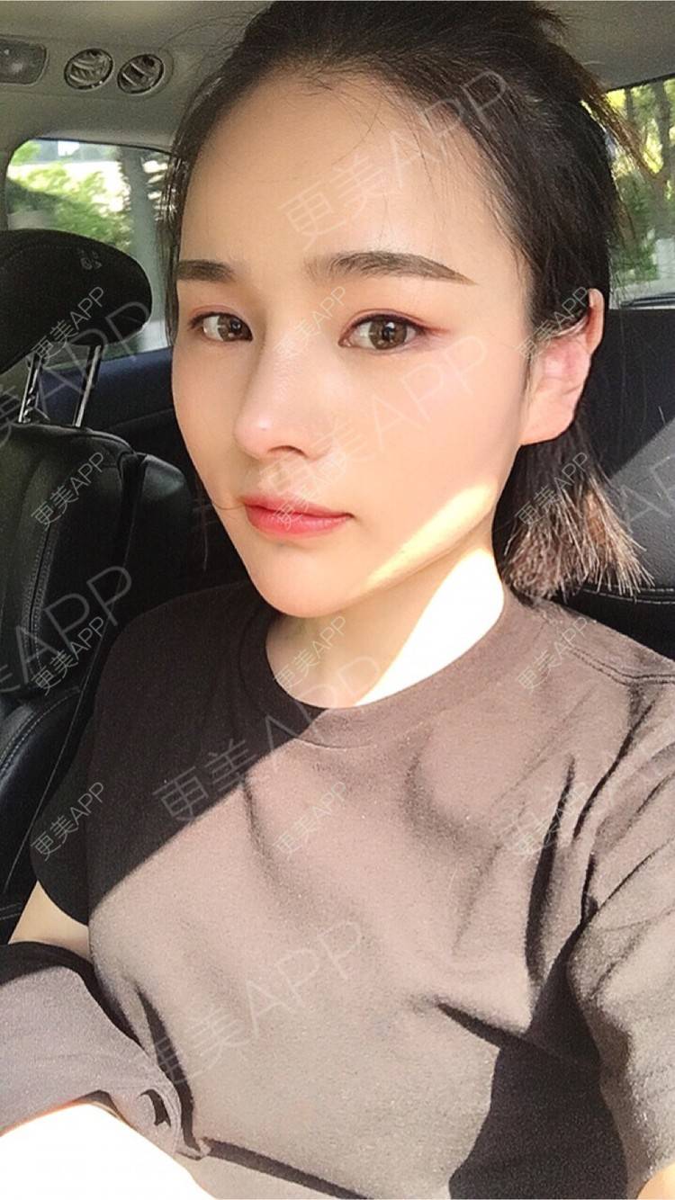 更美 - 更美用户7JqOSIso4n的鼻部多项经验 | 假体取出 | 肋软骨垫鼻尖 | 鼻部多项 | 杭州
