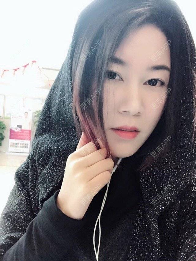 更美 - 这么美辣么帅的玻尿酸鼻部经验 | 玻尿酸太阳穴 | 玻尿酸鼻部 | 深圳