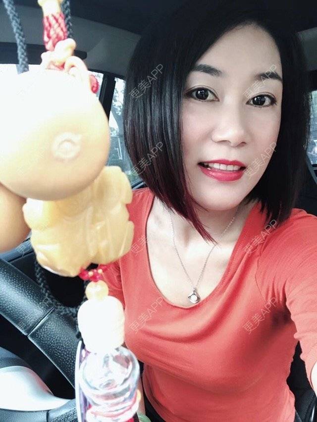 更美 - 这么美辣么帅的玻尿酸鼻部经验 | 玻尿酸太阳穴 | 玻尿酸鼻部 | 深圳