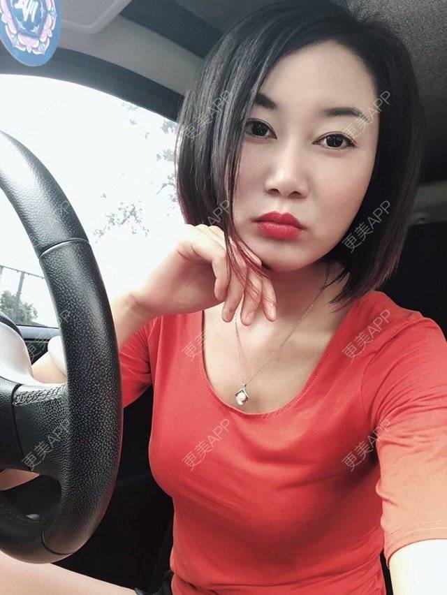 更美 - 这么美辣么帅的玻尿酸鼻部经验 | 玻尿酸太阳穴 | 玻尿酸鼻部 | 深圳