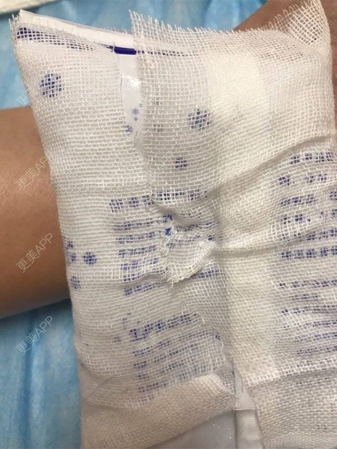 更美 - 更美用户3222258361的祛斑祛色素经验 | 洗纹身 | 祛斑祛色素 | 广州