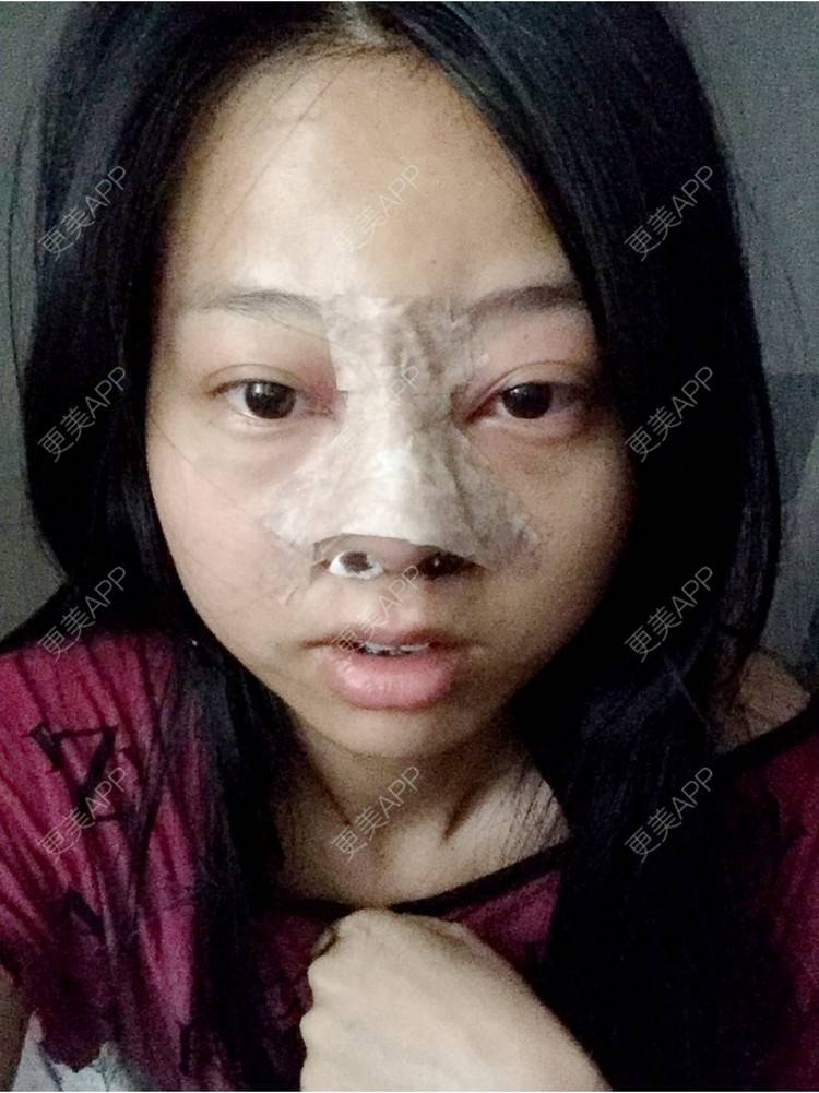 更美 - 🍭会飞的鱼儿的经验 | 鼻综合五项 | 隆鼻假体 | 深圳 | 鼻中隔延长