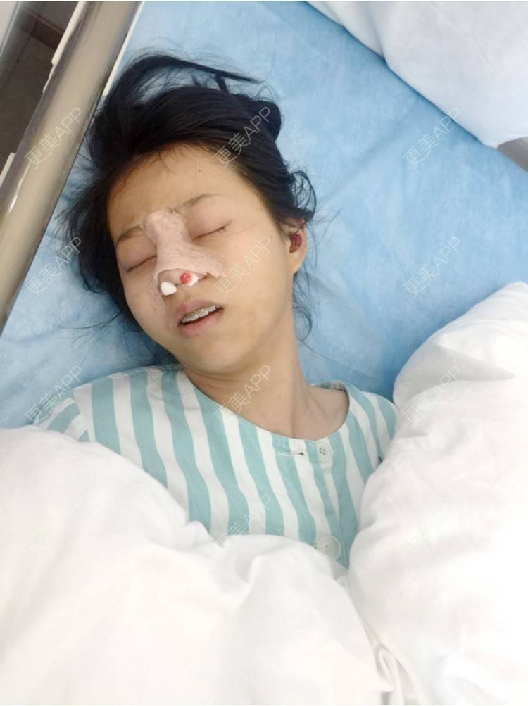 更美 - 🍭会飞的鱼儿的经验 | 鼻综合五项 | 隆鼻假体 | 深圳 | 鼻中隔延长
