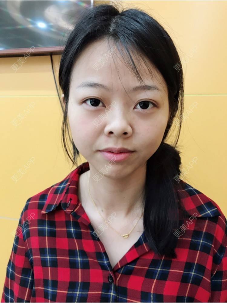 更美 - 🍭会飞的鱼儿的经验 | 鼻综合五项 | 隆鼻假体 | 深圳 | 鼻中隔延长