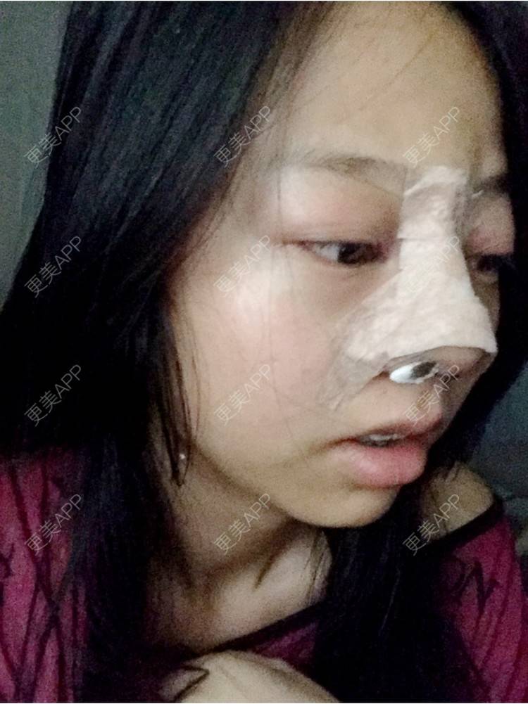 更美 - 🍭会飞的鱼儿的经验 | 鼻综合五项 | 隆鼻假体 | 深圳 | 鼻中隔延长