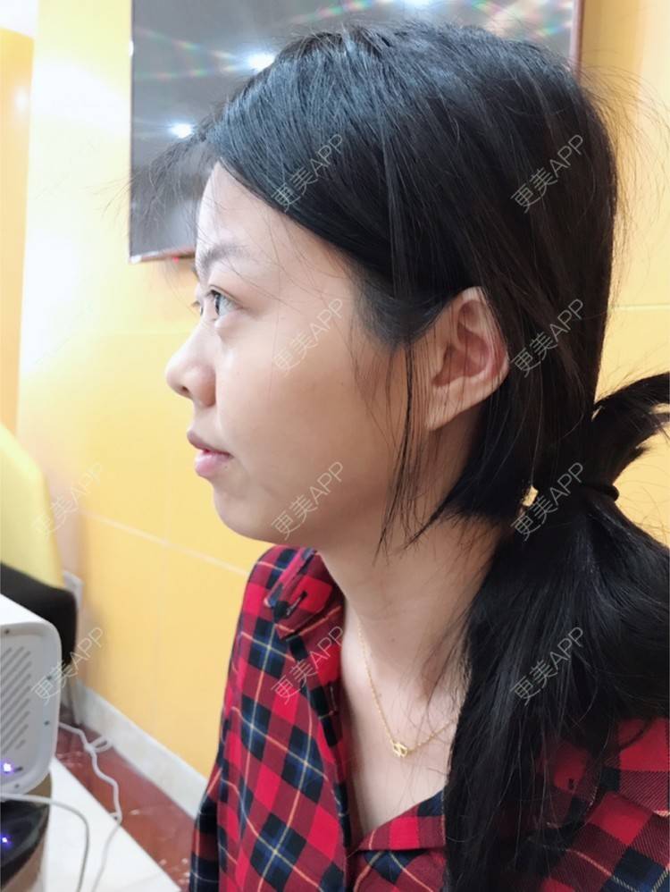 更美 - 🍭会飞的鱼儿的经验 | 鼻综合五项 | 隆鼻假体 | 深圳 | 鼻中隔延长