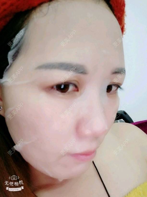 更美 - Suki Liang的自体脂肪全面部填充经验 | 自体脂肪全面部填充 | 视频日记 | 长沙