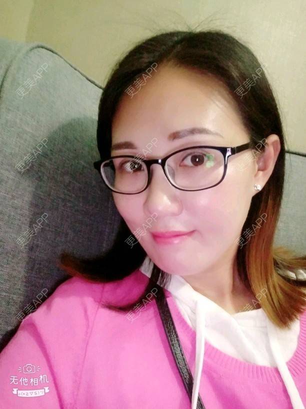 更美 - Suki Liang的自体脂肪全面部填充经验 | 自体脂肪全面部填充 | 视频日记 | 长沙