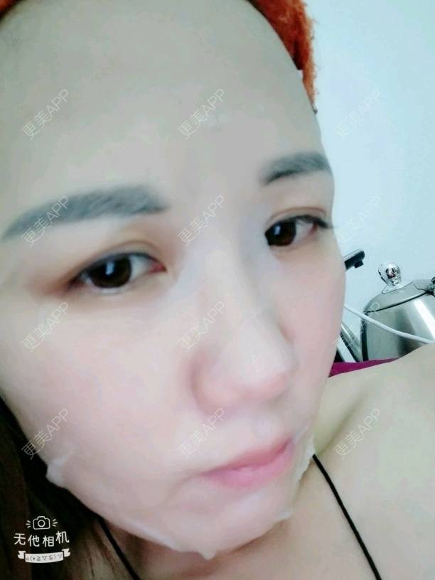 更美 - Suki Liang的自体脂肪全面部填充经验 | 自体脂肪全面部填充 | 视频日记 | 长沙