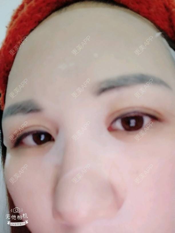 更美 - Suki Liang的自体脂肪全面部填充经验 | 自体脂肪全面部填充 | 视频日记 | 长沙