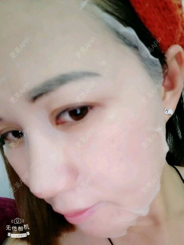 更美 - Suki Liang的自体脂肪全面部填充经验 | 自体脂肪全面部填充 | 视频日记 | 长沙