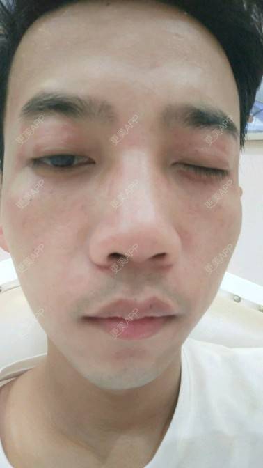 更美 - 忐忑不安😂的皮秒激光经验 | 皮秒激光 | 厦门
