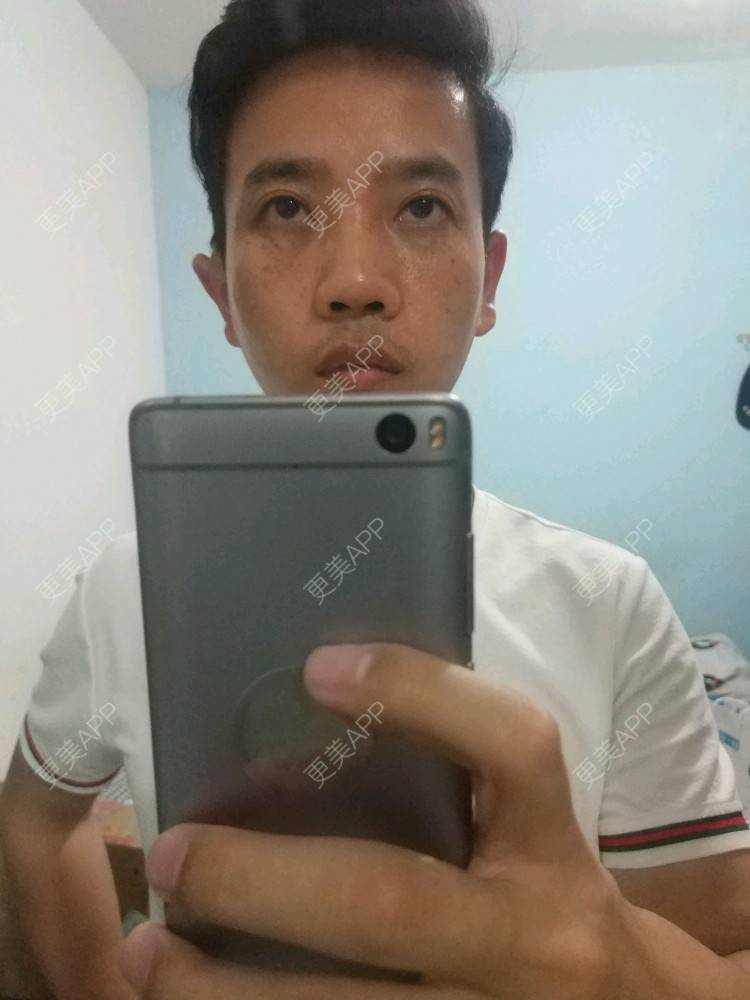 更美 - 忐忑不安😂的皮秒激光经验 | 皮秒激光 | 厦门