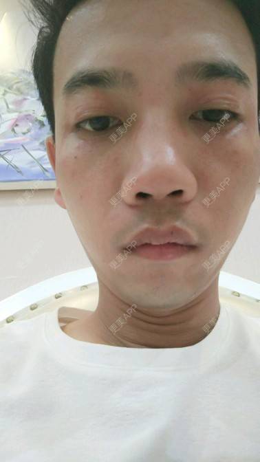 更美 - 忐忑不安😂的皮秒激光经验 | 皮秒激光 | 厦门