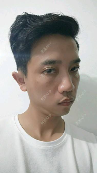 更美 - 忐忑不安😂的皮秒激光经验 | 皮秒激光 | 厦门