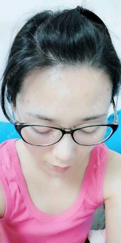 靠近女神的植发际线日记