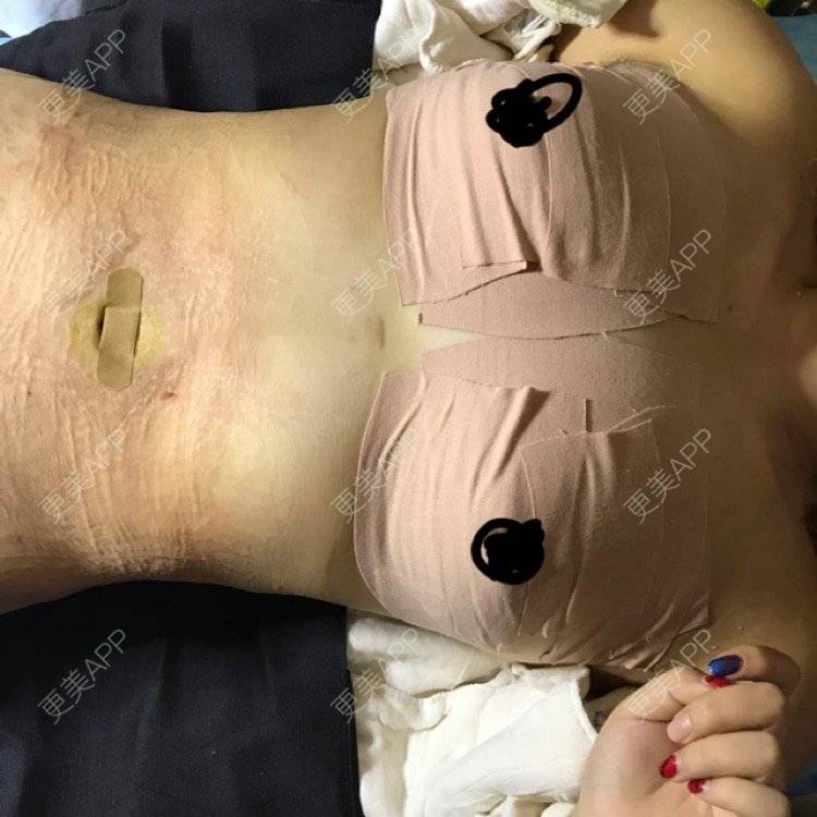 更美用户o8ogxunajf的自体脂肪隆胸日记