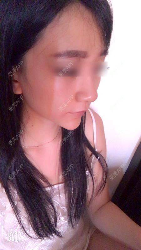 更美用户Gz1GPA3Nzl的隆鼻