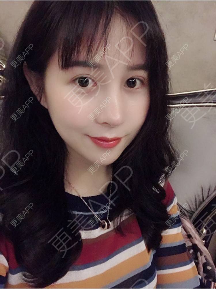 更美 - 更美用户HmkyKrDi85的肋软骨隆鼻经验 | 杭州 | 肋软骨隆鼻 | 假体隆鼻修复术