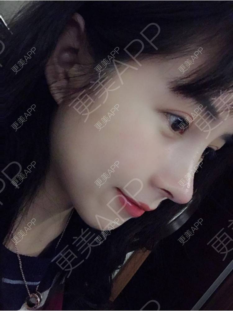 更美 - 更美用户HmkyKrDi85的肋软骨隆鼻经验 | 杭州 | 肋软骨隆鼻 | 假体隆鼻修复术