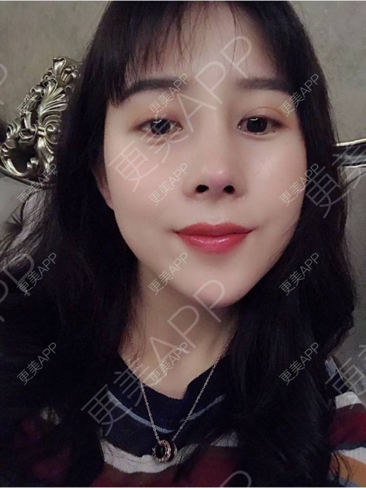 更美 - 更美用户HmkyKrDi85的肋软骨隆鼻经验 | 杭州 | 肋软骨隆鼻 | 假体隆鼻修复术