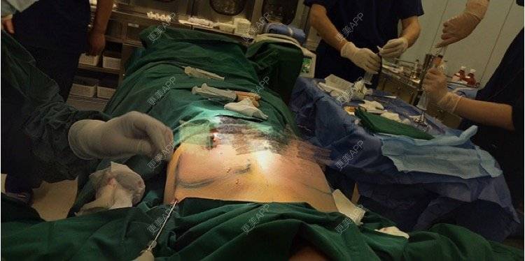 狗屎男人的自体脂肪隆胸日记